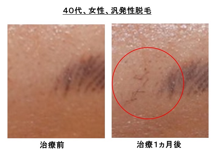 円形脱毛症　病院